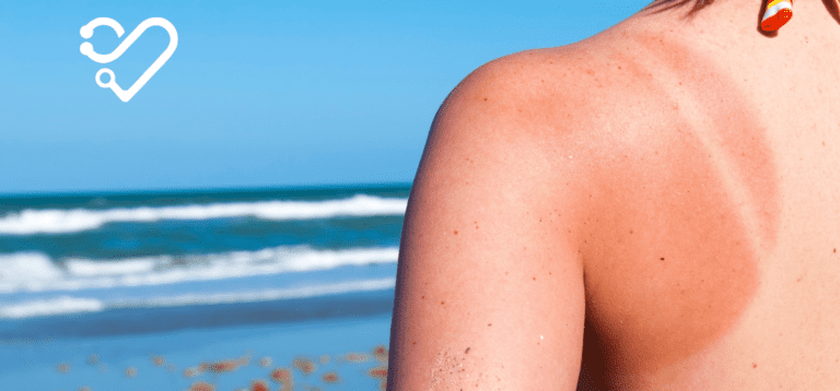 17 Remedios Caseros para Quemaduras Solares que Curarán tu Piel Rápidamente, Según los Dermatólogos